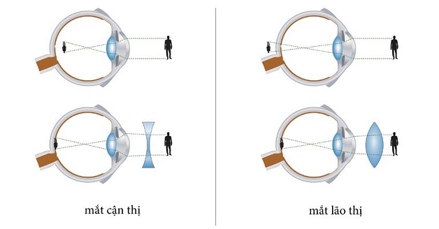 Sự khác biệt giữa thấu kính hội tụ và phân kỳ trong điều trị tật khúc xạ.